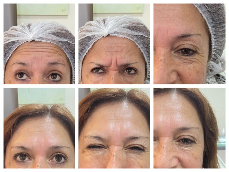 Toxina botulínica Nabota - Tratamiento facial antiarrugas