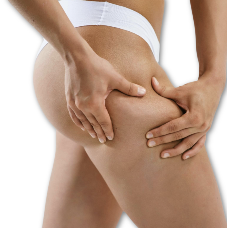 TRATAMIENTO PARA CELULITIS