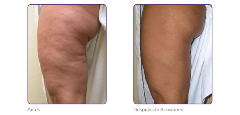 TRATAMIENTO PARA CELULITIS