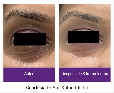Lifting de ojos sin cirugía con Endymed FSR