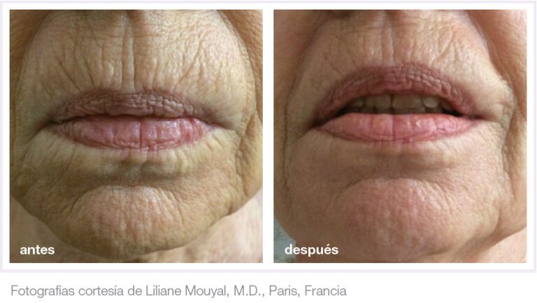ENDYMED INTENSIF ROSTRO+CUELLO+ PAPADA