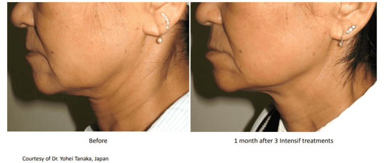 ENDYMED INTENSIF ROSTRO+CUELLO+ PAPADA