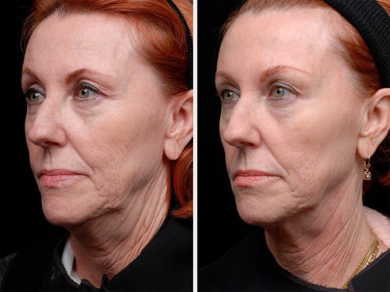 RADIOFRECUENCIA ENDYMED ROSTRO/CUELLO/ CORPORAL