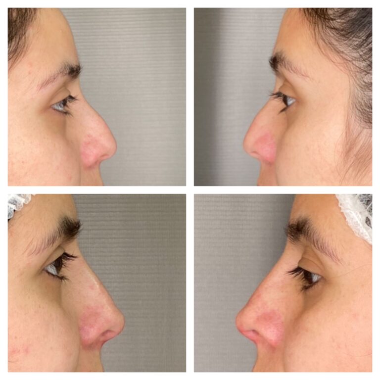 RINOMODELACIÓN CON ACIDO HIALURONICO