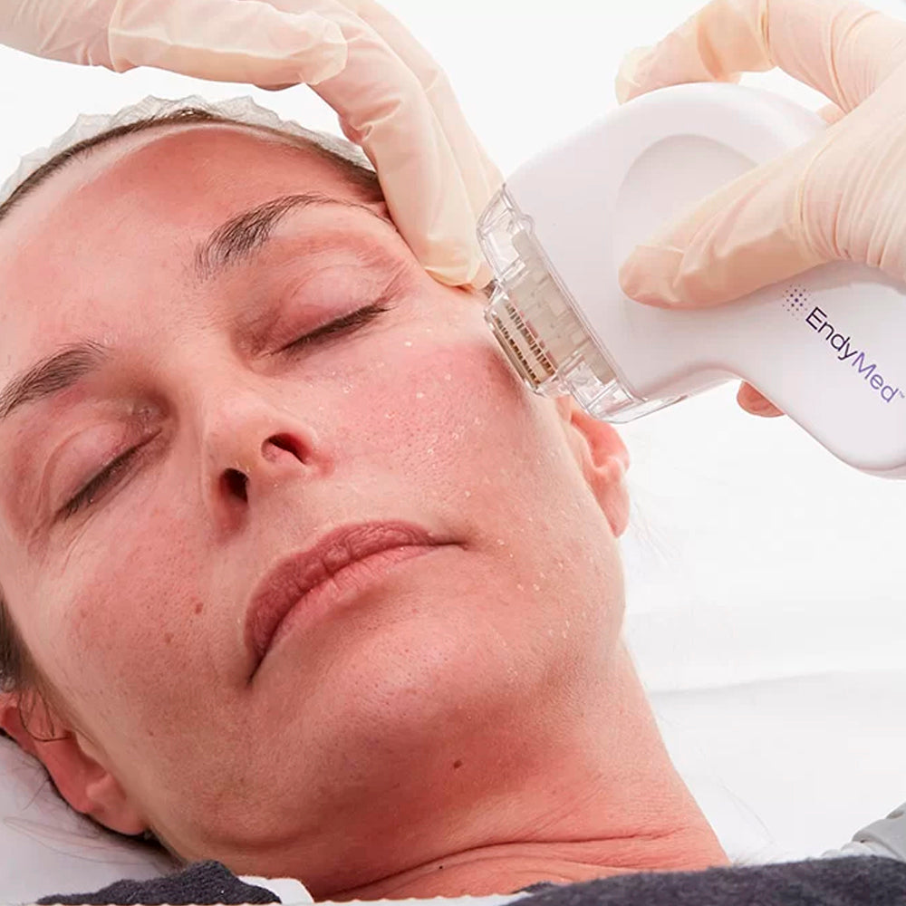 Lifting de ojos sin cirugía con Endymed FSR