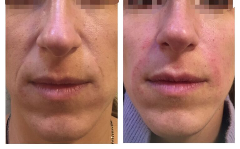 RELLENO DE SURCO NASOGENIANO , LINEA DE MARIONETA O SURCO NASOYUGAL