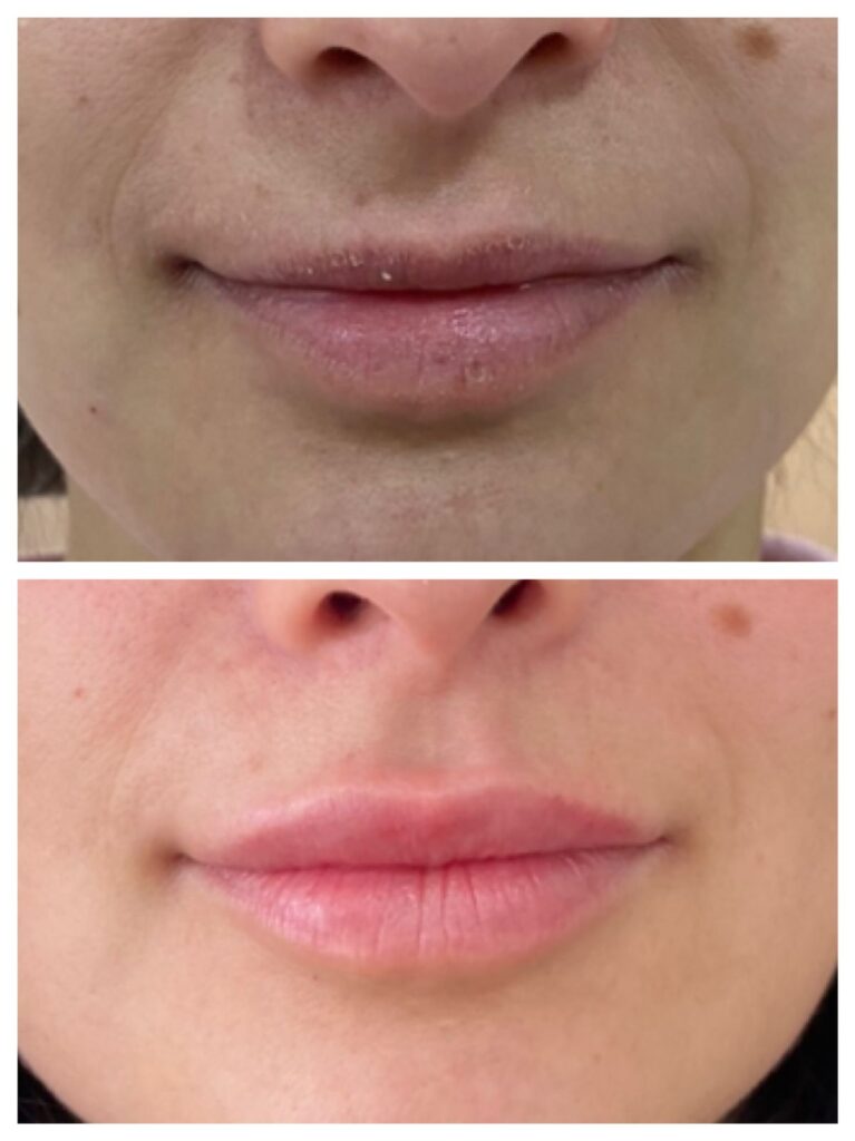 Volumen y perfilado de labios con Ácido Hialurónico