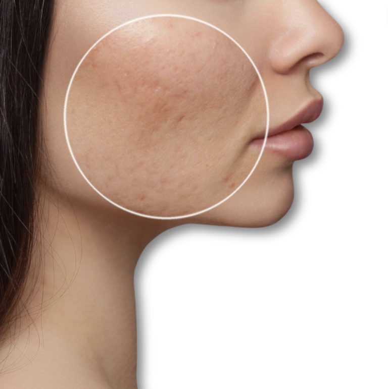 ENDYMED INTENSIF CICATRICEZ ACNE/ ESTRIAS