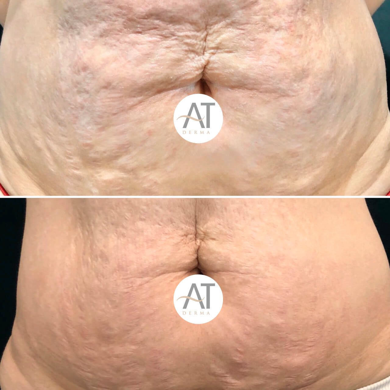 ENDYMED INTENSIF CICATRICEZ ACNE/ ESTRIAS