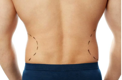 Criolipolisis 360 Clatuu