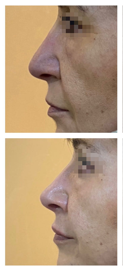 RINOLIPS (RINOMODELACION + VOLUMEN Y/O PERFILADO DE LABIOS