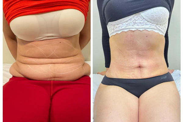 CRIOSHAPE - REDUCTIVO CORPORAL -