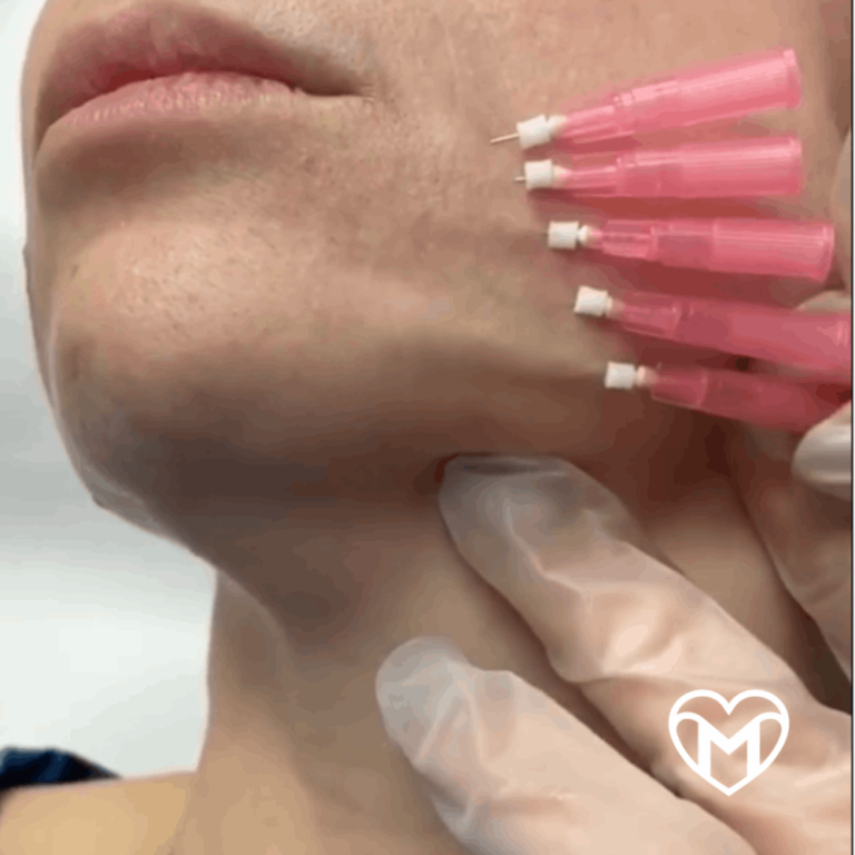 Hilos Revitalizantes PDO – Tensor Facial Biocompatible y Reabsorbible