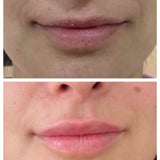 Volumen y perfilado de labios con Ácido Hialurónico