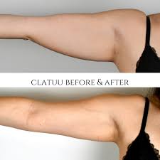 Criolipolisis 360 Clatuu