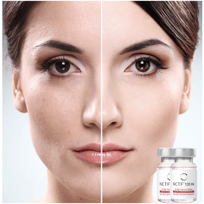 Mesoterapia NCTF 135HA – Cóctel de Vitaminas Facial