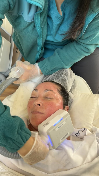 CrioLifting / Tensado de piel - eliminar papada